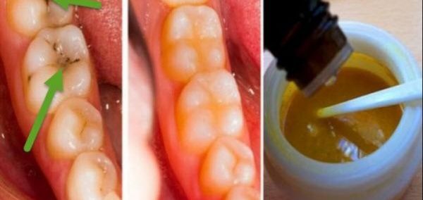 كيف تمنع تسوس الاسنان الى الابد ؟